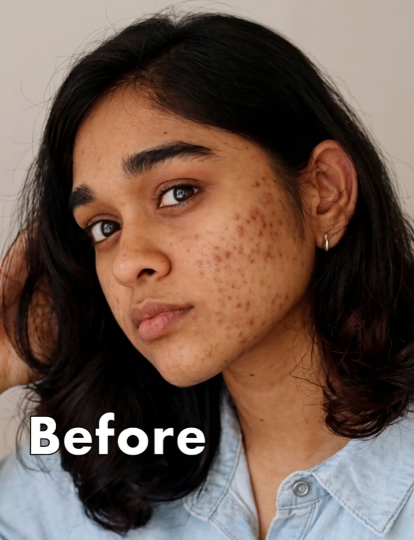 Before Pore Treatment