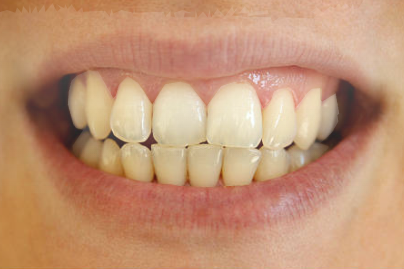Before Mouthwash Treatment